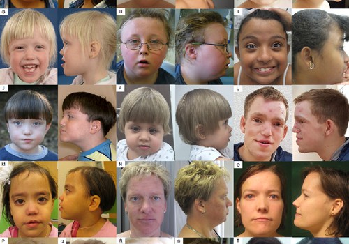 11 gadi līdz diagnozei -ADNP sindroms