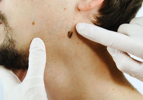 Dermatologs: “Ja melanoma tiks atklāta vēlās stadijās, no tās gada laikā nomirs tikpat daudz cilvēku kā no Covid-19.”