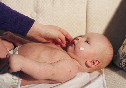 Kas jāzina par ekzēmu uz mazuļa ādas